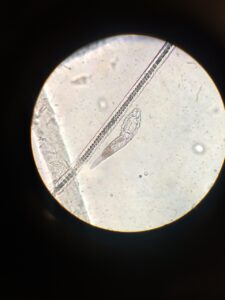 フェイスラインのニキビを繰り返す原因と食生活の見直し方法は？